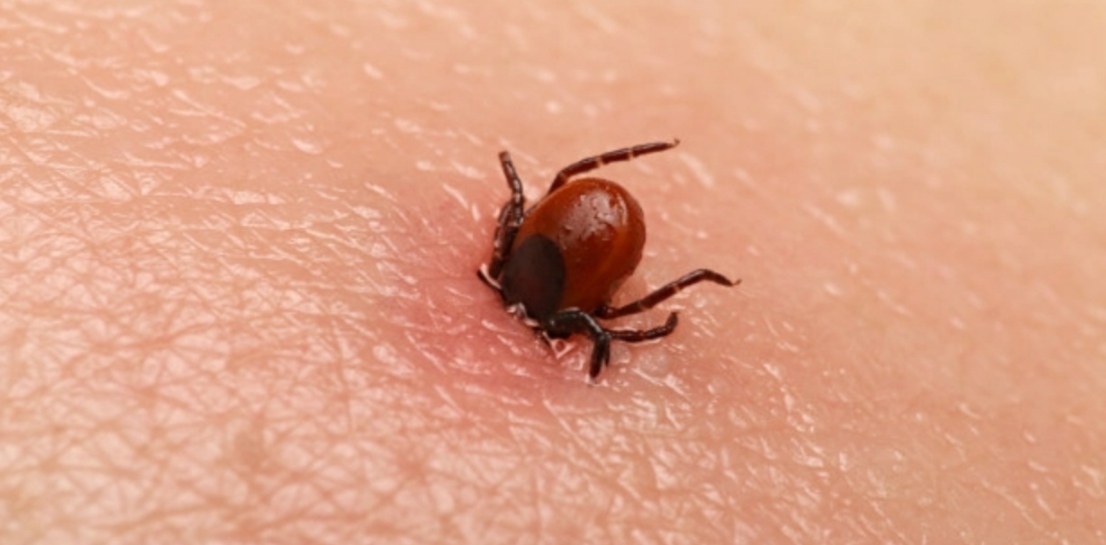 Scrub typhus caught another girl in Jalandhar, got admitted in PGI Chandigarh