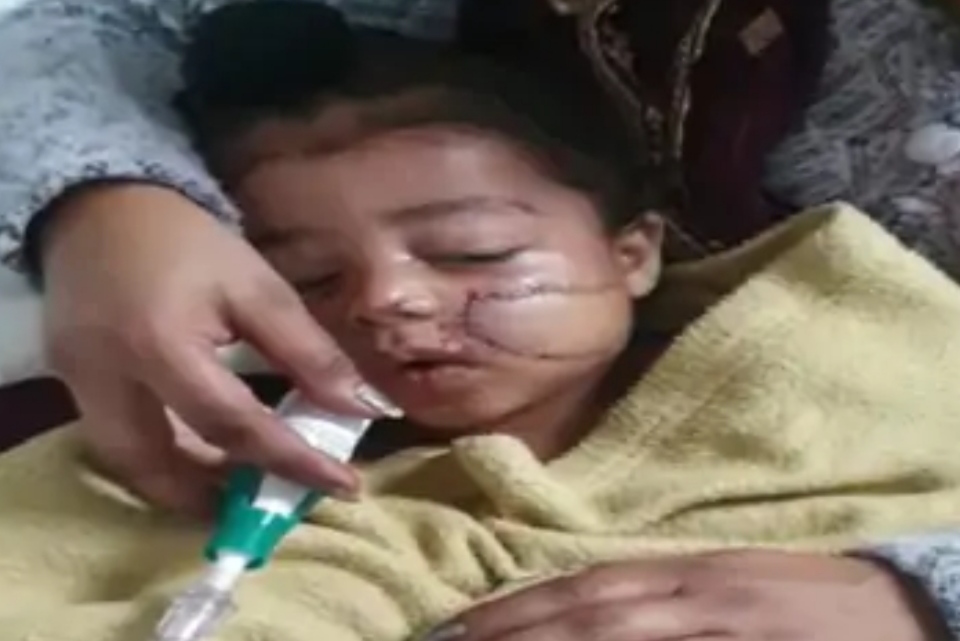 The child came in the grip of plastic door, 120 stitches on the face