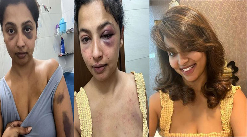 Ex-boyfriend beat this famous actress so much that this condition happened