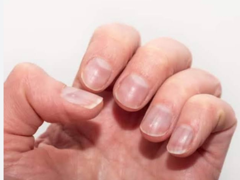 Are such white marks visible in your nails? So know the reason behind this