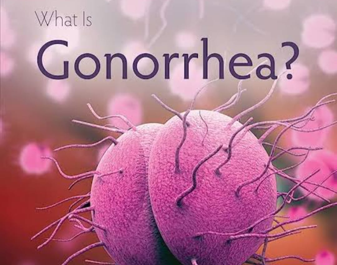 What is Gonorrhea? Know its symptoms, causes and treatment.