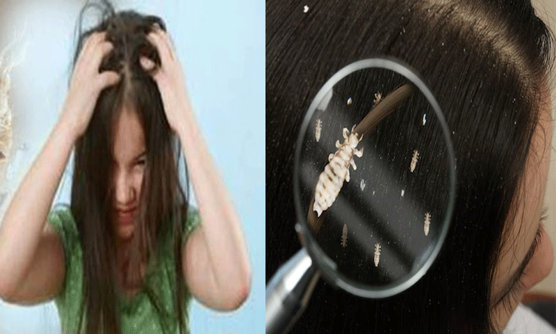 Where do lice get into the hair on your head? How to get rid of them
